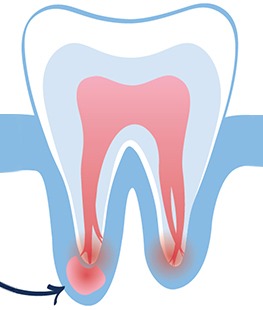 Endodontic Surgery
