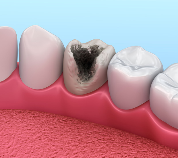 Newport Beach Problems with Tooth Pulp